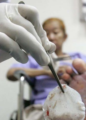 把蛆放在进伤口里 泰国医院尝试用蛆治病
