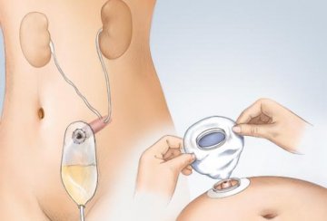 膀胱癌防治完全手册