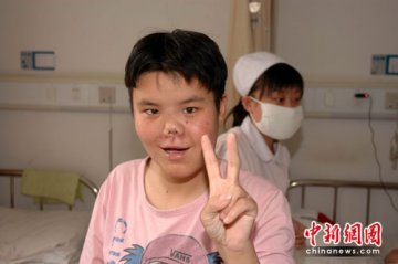 世界首例“坑面女”将进行最后一次手术