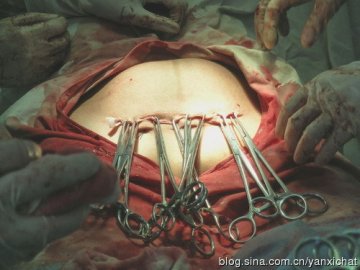 女性很伟大！惊心动魄剖腹产全程