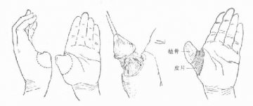 拇指再造