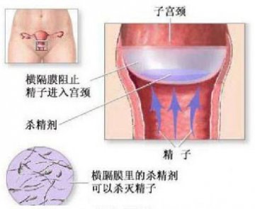 1/5女性皮下埋植避孕可致月经紊乱 严重者致癌