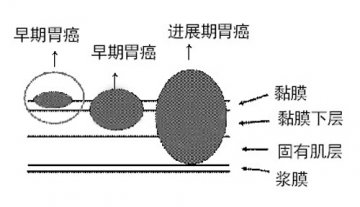 胃癌早期检出率决定治疗效果