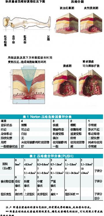 压疮护理：不仅仅是解压