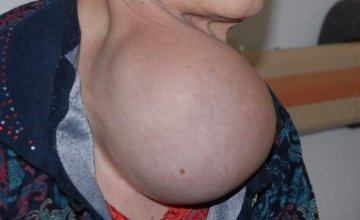 二院成功切除罕见巨大甲状腺肿物