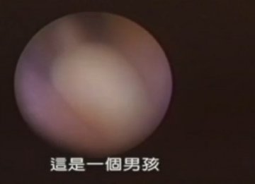 实拍：美国堕胎手术全过程