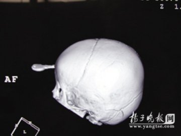 男童额头正中插钥匙 医生揭头皮手术保容貌
