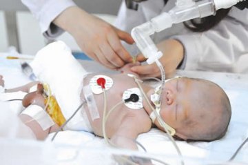 腹裂新生儿肠胃长出体外 “产时手术”拯救畸形儿