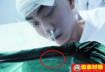 男子用青蛙腿敷牙治痛引虫入脑