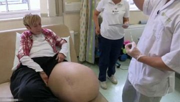 英女子患巨腿症双腿重达108kg