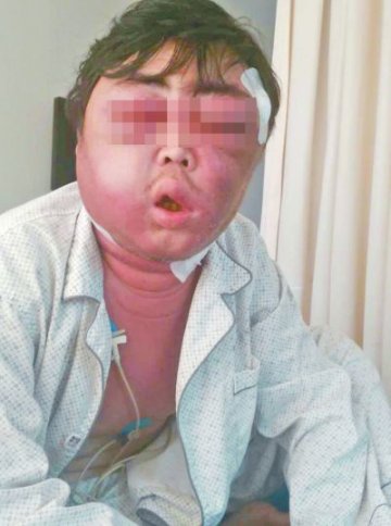 被蚊子叮一下面肿成球 夏季防蚊四法宝