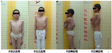 大坪医院脊柱外科再次成功实施严重脊柱后凸畸形矫形手术1例