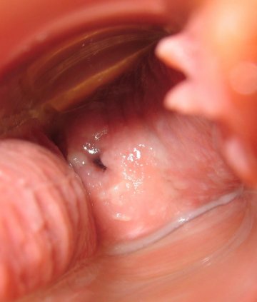 医学探索：实拍未育女性经期宫颈每天变化