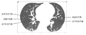 正常胸部肺窗CT（5）