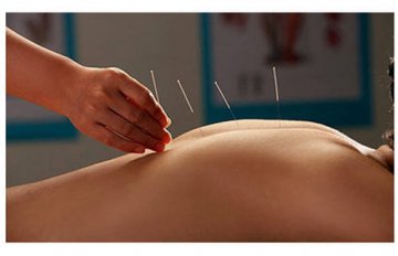 针灸减肥健康效果佳
