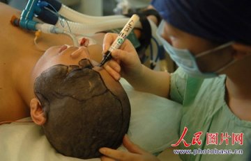 男子脸上长黑毛上海成功实施换脸手术