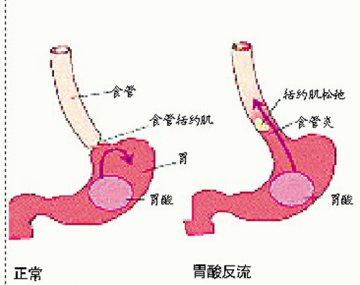 胃病怎会误诊为哮喘？