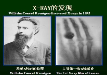 科普：放射治疗，你了解多少