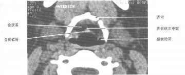 正常喉部CT（1）