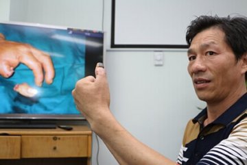 中山一院：断指30个小时也能“复活”
