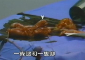 实拍：美国堕胎手术全过程