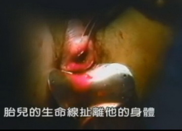 实拍少女人流全过程