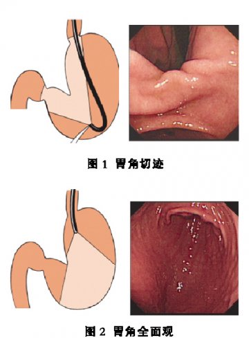 胃角的观察：进退之间，低位反转