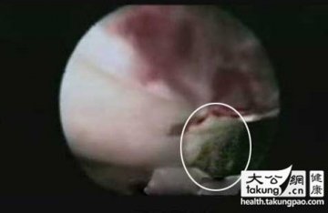 神奇的生命：实拍女性排卵真实过程