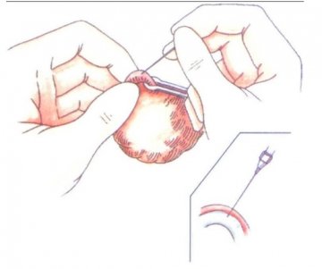 输精管粘堵术