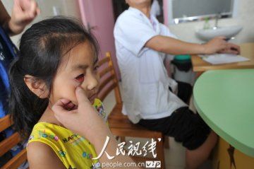 合肥：红眼病患儿骤增