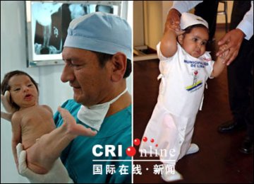 秘鲁小美人鱼分腿成功 迈出人生第一步