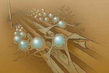 脑部白质注入神经干细胞或可治愈帕金森式病