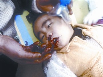 三岁男孩咳出一尺多长怪物