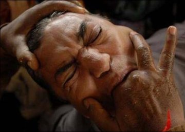 抠喉疗法
