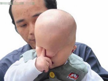 男孩天生无眼医生为其开眼