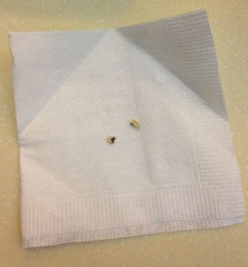 青岛万和春就餐硌掉烤瓷牙 店方被指灭证