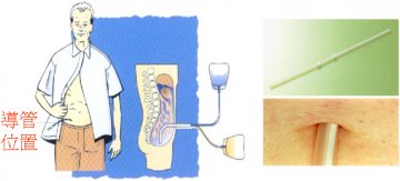 男子自制血透机透析13年 专家支招：腹膜透析可作为首选