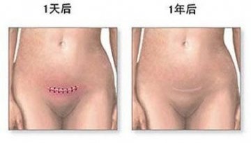 医学实录：女性剖腹产手术全过程