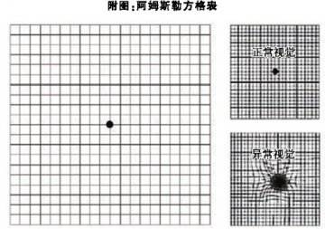 致盲性眼病：“青”“白”之外，还有“一黄”