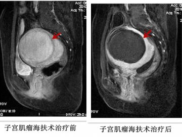 高强度聚焦超声治疗