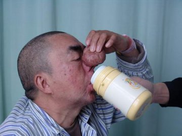 五旬老汉过量饮酒鼻大如橘