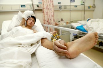 中南大学湘雅医院成功回植寄养断肢