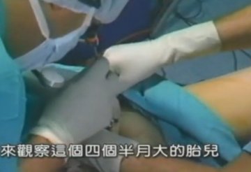 实拍：美国堕胎手术全过程