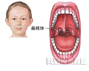 扁桃体切除术