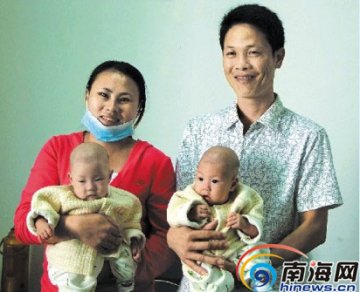 海南首例连体婴儿成功分离：术后能吃能睡