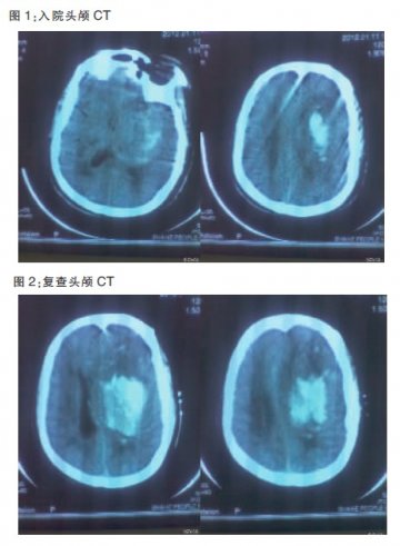 阿司匹林影响凝血： “保守”与“手术”各有所重