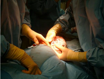 剖腹产宝宝出生瞬间
