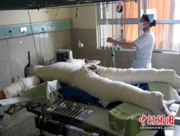 男子掉高浓度硫酸池 全身死皮多达30余斤