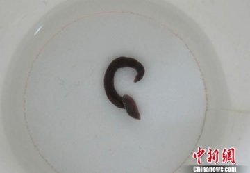 2岁女孩喝生水致支气管里长蚂蝗