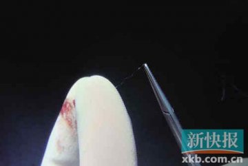 女子自称成整形试验品 全身被埋线痛不欲生